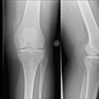 synovite villo-nodulaire focale avec contingents en situation pré-condylienne antéro-latérale et sous-patellaire Radiographie synovite villo-nodulaire focale avec contingents en situation pré-condylienne antéro-latérale et sous-patellaire Radiographie