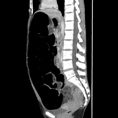 Occlusion mécanique colique sur endométriose digestive TDM Sagittal