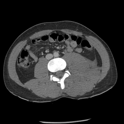 Thoracic Injuries, Spinal Injuries L5, Traumatic disc herniation Abdomen CT, Portal venous phase, Axial plane