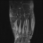 Fracture de contrainte du tiers moyen du 4ème métatarse droit Coronal DP fat sat Fracture de contrainte du tiers moyen du 4ème métatarse droit Coronal DP fat sat