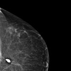 Récidive tardive de cancer du sein gauche 1-LCC Récidive tardive de cancer du sein gauche 1-LCC