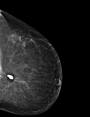 Récidive tardive de cancer du sein gauche 1-LCC