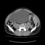 Lymphangiome kystique. TDM Abdomen Axial Temps veineux Lymphangiome kystique. TDM Abdomen Axial Temps veineux