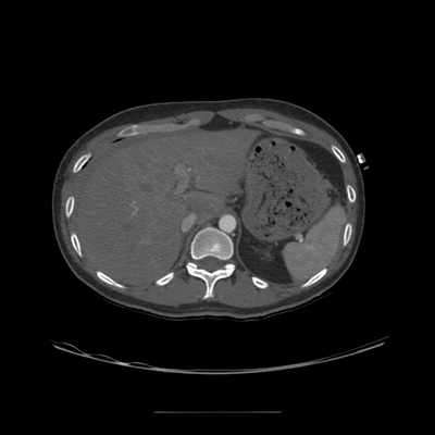 fracture du condyle occipital, traumatisme thoracique, fracture et contusion hépatique, hématome de la surrénale TAP artériel axial
