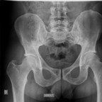 Conflit fémoro acétabulaire radiographie standart bassin de face Conflit fémoro acétabulaire radiographie standart bassin de face