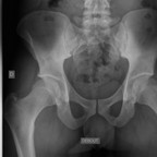 Sacroiliite inflammatoire Radiographie du bassin Sacroiliite inflammatoire Radiographie du bassin