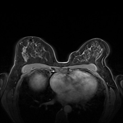 Carcinome canalaire in situ supéro-médian droit Dynamique FS 2 min