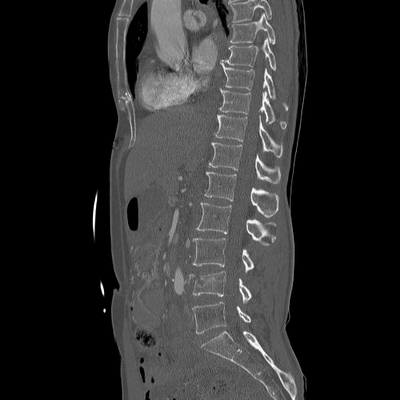 Craniocerebral trauma, Carotid artery injury with dissection, traumatic perforation of GI tract, pulmonary artery injury, Chance fracture Dorsal and lumbar spine, Sagittal plane, Bone window