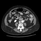 Diverticulite sigmoidienne avec ovarite bilatérale TDM Abdomen Axial Temps veineux Diverticulite sigmoidienne avec ovarite bilatérale TDM Abdomen Axial Temps veineux