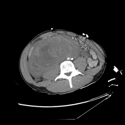 Renal vein rupture, Adrenal hemorrhage Abdomen CT, Portal venous phase, Axial plane