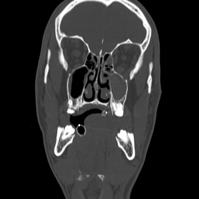 Cranioencephalic trauma, Facial fracture, Thoracic injuries, Pelvic fracture, Spleen and renal trauma Face CT, Coronal plane, Bone window
