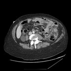 Perforation d'un diverticule jéjunal TDM Abdomen Pelvis Axial Temps veineux Perforation d'un diverticule jéjunal TDM Abdomen Pelvis Axial Temps veineux