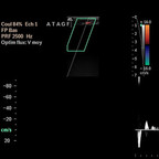 Ischémie aiguë du membre inférieure droit sur embole cruorique. Echographie Membre inférieur Ischémie aiguë du membre inférieure droit sur embole cruorique. Echographie Membre inférieur