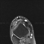 Fissuration longitudinale du tendon du court fibulaire IRM Membre inférieur Axial Fat Sat Fissuration longitudinale du tendon du court fibulaire IRM Membre inférieur Axial Fat Sat