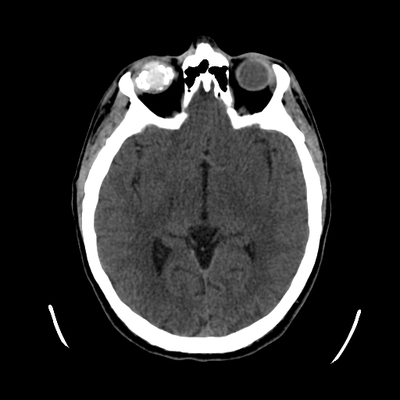 Thoracic Injuries, Spinal Injuries L5, Traumatic disc herniation Head CT, Axial plane, Soft tissue window