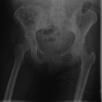 Ostéome neurogène ou para-ostéo-arthropathie neurogène Bassin (face au lit) Ostéome neurogène ou para-ostéo-arthropathie neurogène Bassin (face au lit)
