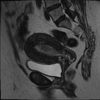 Néoplasie endométriale classée Figo IB Sagittal T2 Néoplasie endométriale classée Figo IB Sagittal T2