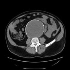 Rupture d'anévrysme de l'aorte abdominale Sans injection Rupture d'anévrysme de l'aorte abdominale Sans injection