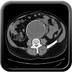 Rupture d'anévrysme de l'aorte abdominale Sans injection