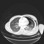 Pneumothorax et contusion pulmonaire post traumatiques avec emphysème sous cutané et médiastinal Axial poumons Pneumothorax et contusion pulmonaire post traumatiques avec emphysème sous cutané et médiastinal Axial poumons