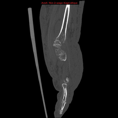 Chondrocalcinose  TDM Membre supérieur Sagittal