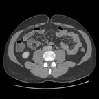 Diverticulite sigmoidienne perforée dans le mésosigmoide. TDM Abdomen Pelvis Axial temps portal Diverticulite sigmoidienne perforée dans le mésosigmoide. TDM Abdomen Pelvis Axial temps portal