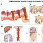 Cancer colorectal - Staging TNM du cancer du rectum classification Cancer colorectal - Staging TNM du cancer du rectum classification
