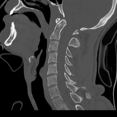 Thoracic Injuries, Subcapsular hemorrhage of liver, Pelvic injury Cervical spine, Sagittal plane, Bone window