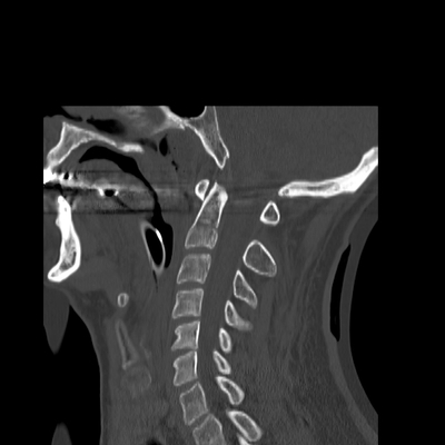 fracture du condyle occipital, traumatisme thoracique, fracture et contusion hépatique, hématome de la surrénale rachis cervical sag os