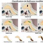 Pancréatite aigue Classification de Balthazar modifiée (CTSI) Pancréatite aigue Classification de Balthazar modifiée (CTSI)