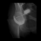 Arthrite de la hanche Arthrographie Arthrite de la hanche Arthrographie