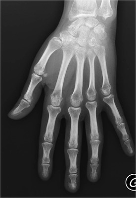 Polyarthrite rhumatoïde  Radiographie Main gauche
