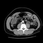 Appendicite aigue compliquée d'une péritonite débutante localisée TDM abdomen pelvis axial veineux Appendicite aigue compliquée d'une péritonite débutante localisée TDM abdomen pelvis axial veineux