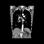 Abcès pulmonaire compliquant un carcinome épidermoïde TDM Thorax Coronal Temps artériel Abcès pulmonaire compliquant un carcinome épidermoïde TDM Thorax Coronal Temps artériel