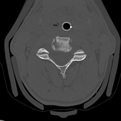 Severe cranioencephalic injuries, Carotid artery dissection, Aspiration pneumonia, Pelvic fracture Cervical spine, Axial plane, Bone window