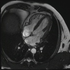 IDM antéro-septo-apical, non viable sans thrombus intracavitaire résiduel CINE TRUFI 4C IDM antéro-septo-apical, non viable sans thrombus intracavitaire résiduel CINE TRUFI 4C
