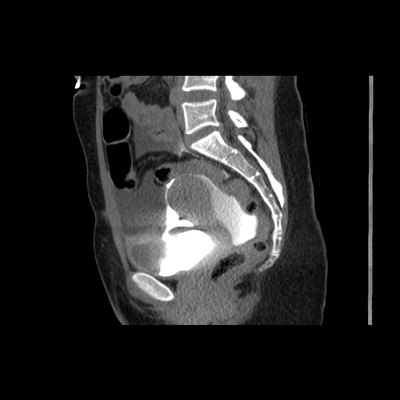 Abdominal vessels trauma, Intraperitoneal bladder rupture, Spleen infarction, Pelvic fracture Pelvic CT, Delayed phase, 15 min