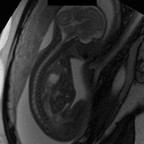 Plug trachéal posé à 30SA et 5J dans le contexte d'une hernie diaphragmatique gauche IRM Thorax Sagittal T2 TRUE FISP 2D Plug trachéal posé à 30SA et 5J dans le contexte d'une hernie diaphragmatique gauche IRM Thorax Sagittal T2 TRUE FISP 2D