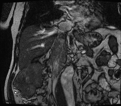 Adénocarcinome rénal droit avec envahissement de la veine rénale et de la VCI Coronal TrueFISP