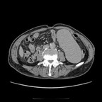 Lymphome splénique. TDM Abdomen Axial Temps tardif Lymphome splénique. TDM Abdomen Axial Temps tardif