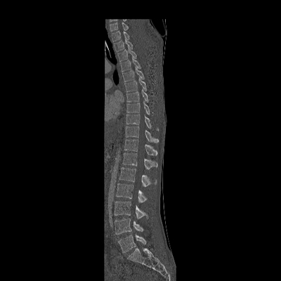 Cranioencephalic injuries, limb injuries, aspiration pneumonia Dorsal and Lumbar spine, Sagittal plane, Bone window
