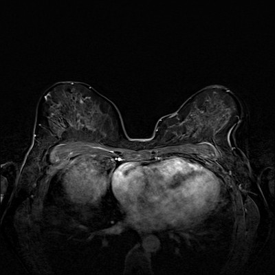 Carcinome canalaire in situ supéro-médian droit Soustraction 3 min