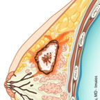 Breast cancer BI-RADS Assessment Categories Breast cancer Breast cancer BI-RADS Assessment Categories Breast cancer