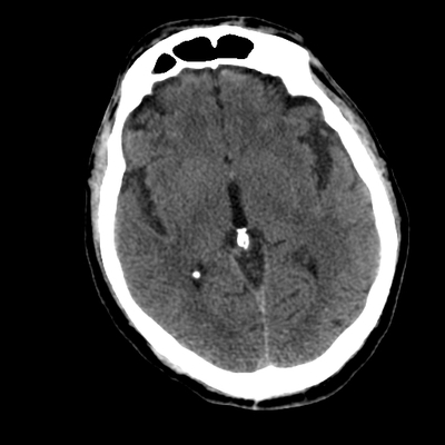 Subarachnoid Hemorrhage, Traumatic, Pneumothorax, Sternum fracture Head CT in soft tissue window
