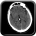 Subarachnoid Hemorrhage, Traumatic, Pneumothorax, Sternum fracture Head CT in soft tissue window