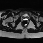 Kyste de Gartner IRM Pelvis Axial T2 Kyste de Gartner IRM Pelvis Axial T2