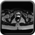 Kyste de Gartner  IRM Pelvis Axial T2