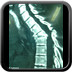 fracture de T3 TDM