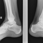 Rupture complète du tendon calcanéen Radiographies chevilles de profil Rupture complète du tendon calcanéen Radiographies chevilles de profil