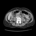 Perforation d'un diverticule duodénal TDM Abdomen Axial Temps veineux Perforation d'un diverticule duodénal TDM Abdomen Axial Temps veineux